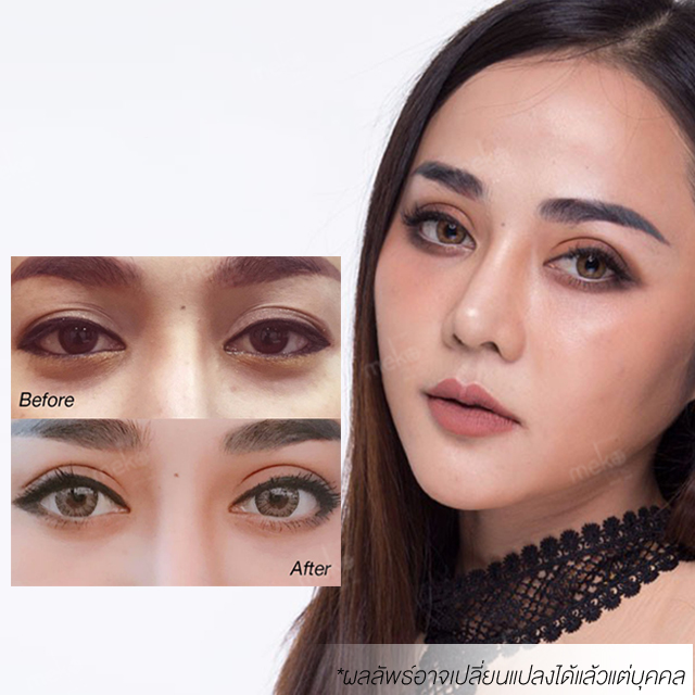 ตาสองชั้น ตาคมเข้มสุด ๆ แบบสาย ฝ. โดยแพทย์ยศ เมโกะ คลินิก ตาสองชั้น ตาคมเข้มสุด ๆ แบบสาย ฝ. โดยแพทย์ยศ เมโกะ คลินิก