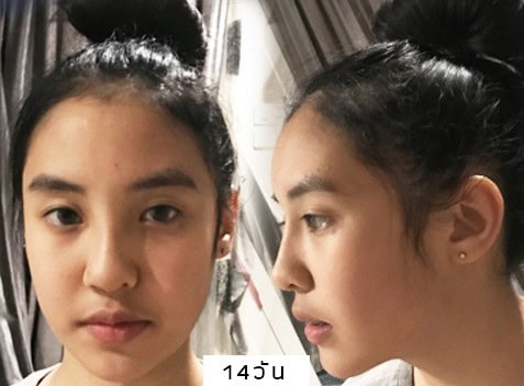 เสริมจมูก หมอมนัส เมโกะคลินิก คุณพลอย
