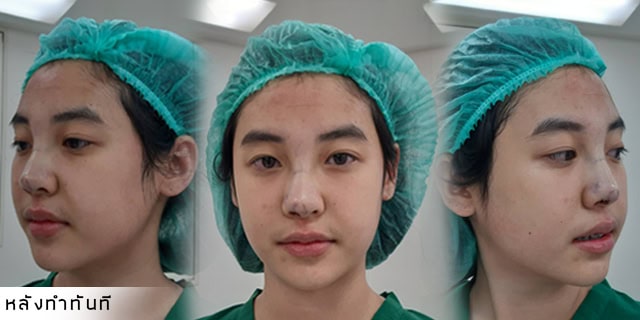 เสริมจมูก หมอมนัส เมโกะคลินิก คุณพลอย