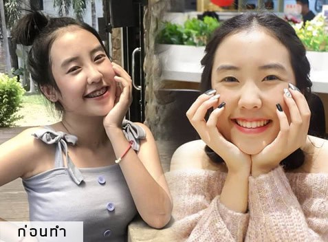เสริมจมูก หมอมนัส เมโกะคลินิก คุณพลอย