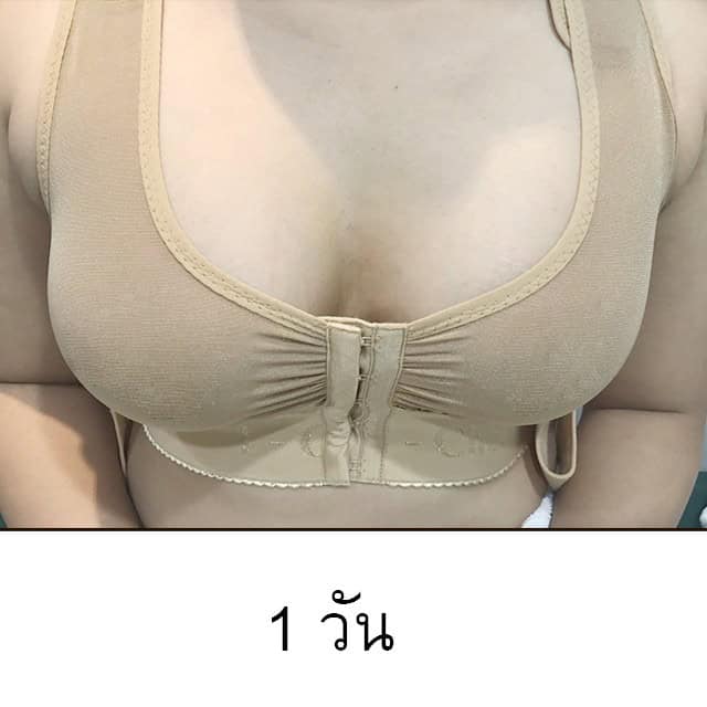 เสริมหน้าอก หมออา เมโกะ คลินิก คุณรัตซึ