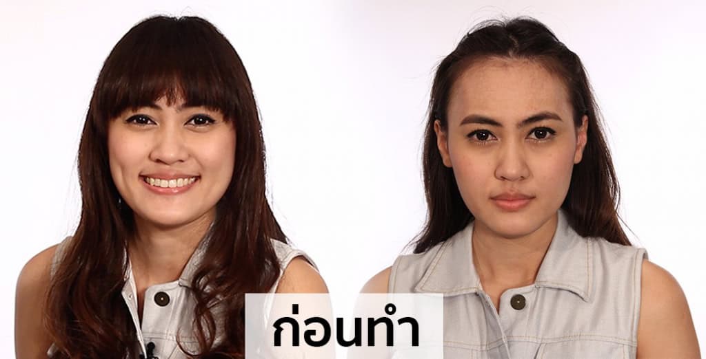 ปลูกผม หมอธิติวัฒน์ เมโกะ MHC คุณน้ำ