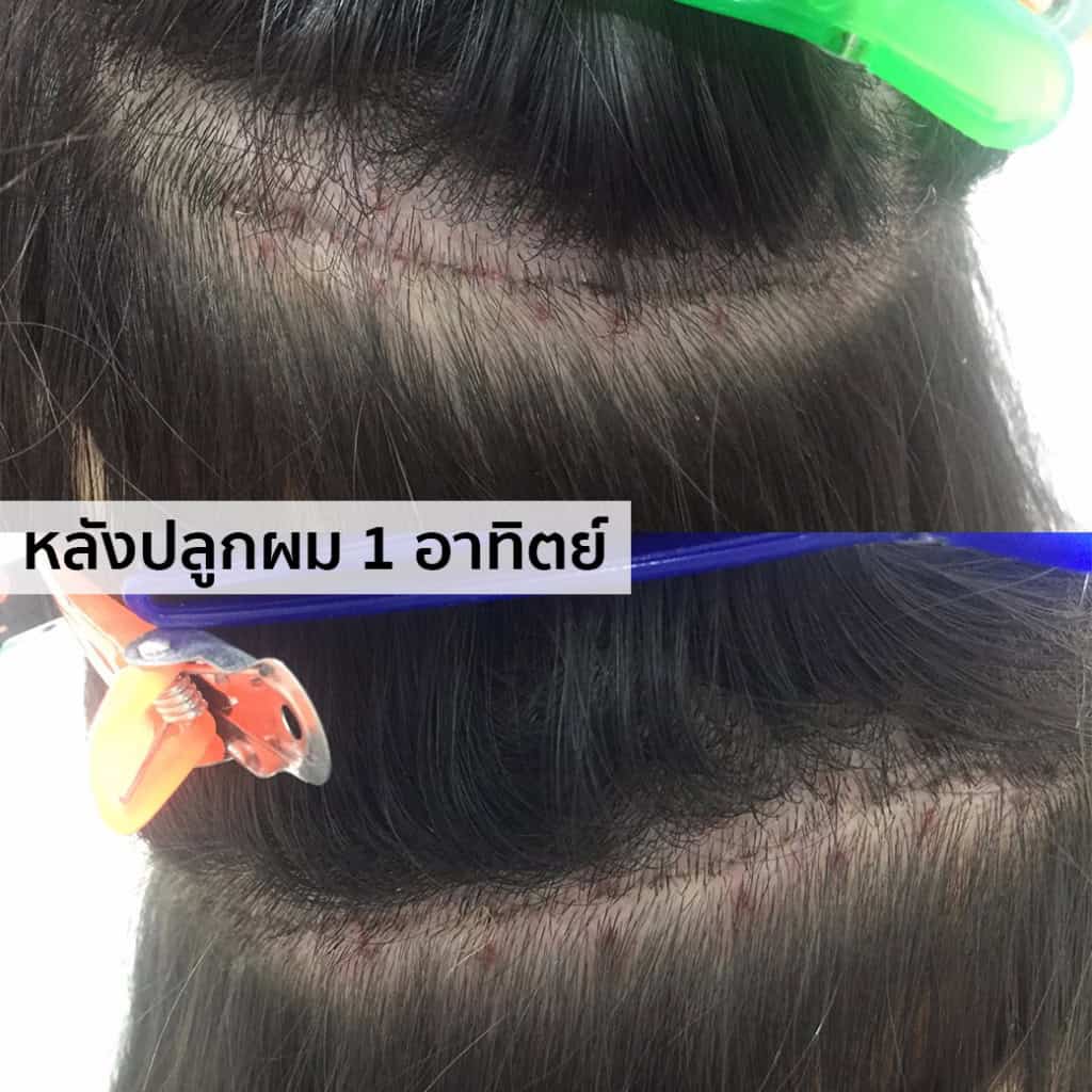 ปลูกผม หมอธิติวัฒน์ เมโกะ MHC คุณน้ำ