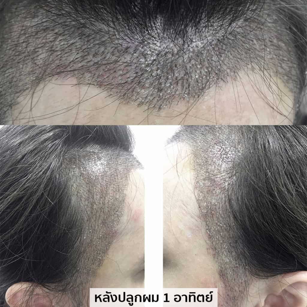 ปลูกผม หมอธิติวัฒน์ เมโกะ MHC คุณน้ำ