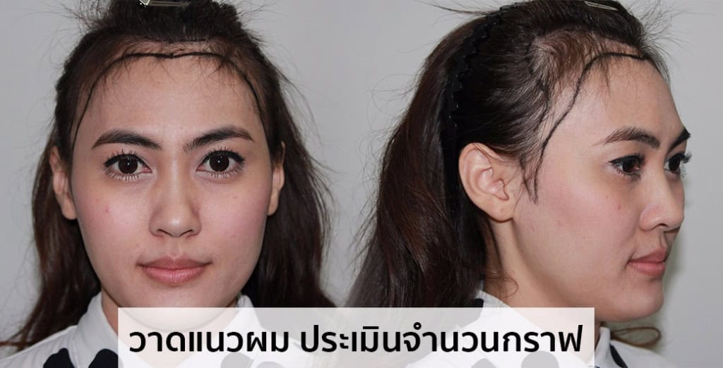 ปลูกผม หมอธิติวัฒน์ เมโกะ MHC คุณน้ำ