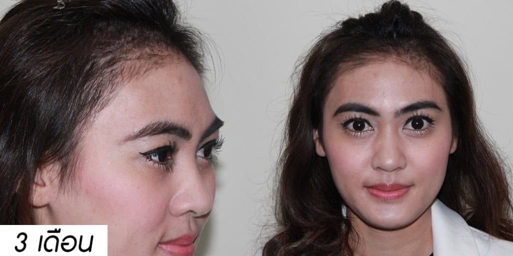 ปลูกผม หมอธิติวัฒน์ เมโกะ MHC คุณน้ำ