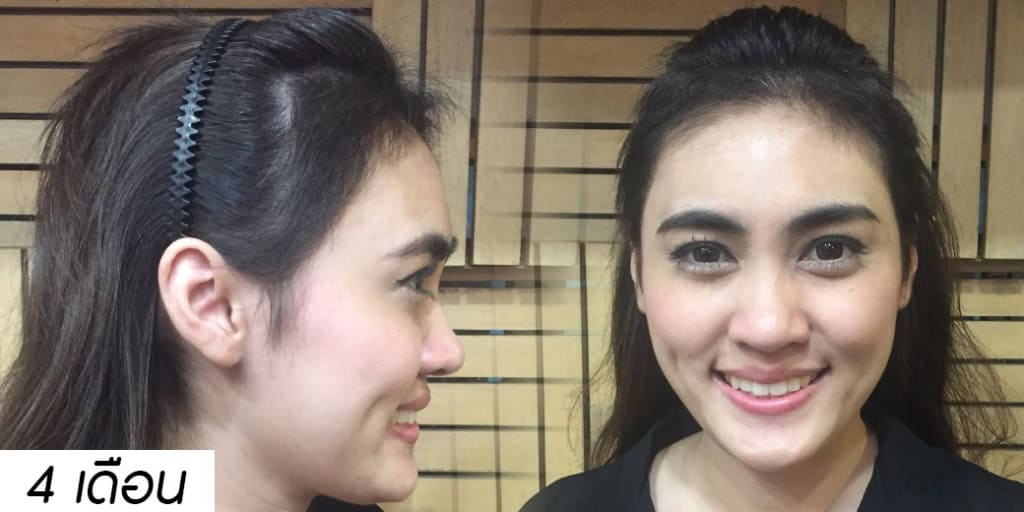 ปลูกผม หมอธิติวัฒน์ เมโกะ MHC คุณน้ำ