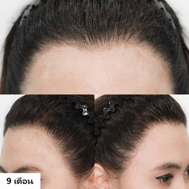 ปลูกผม หมอธิติวัฒน์ เมโกะ MHC คุณน้ำ