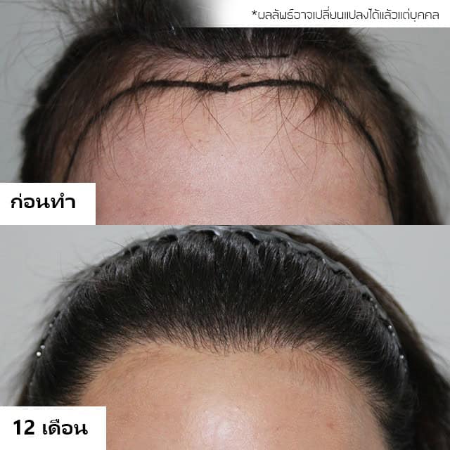 ปลูกผม หมอธิติวัฒน์ เมโกะ MHC คุณน้ำ