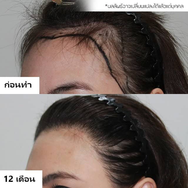 ปลูกผม หมอธิติวัฒน์ เมโกะ MHC คุณน้ำ