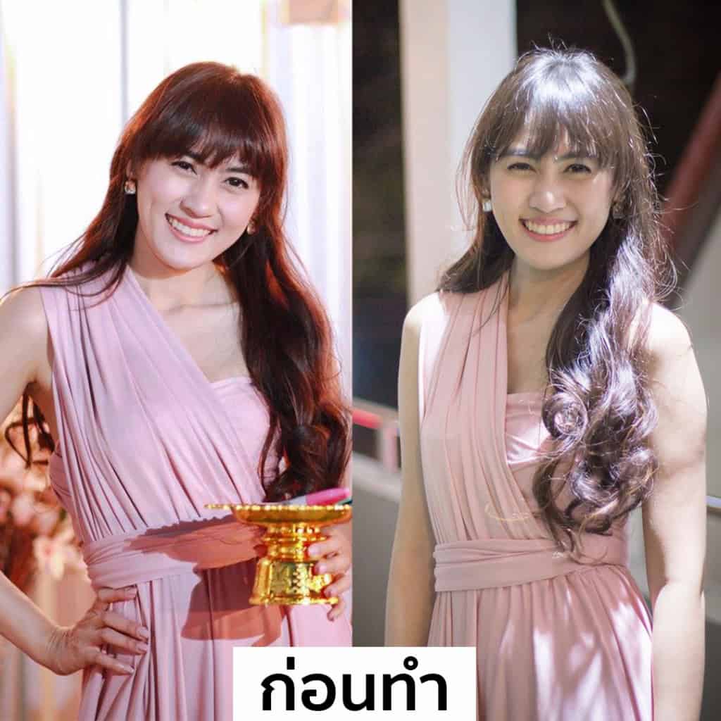 ปลูกผม หมอธิติวัฒน์ เมโกะ MHC คุณน้ำ