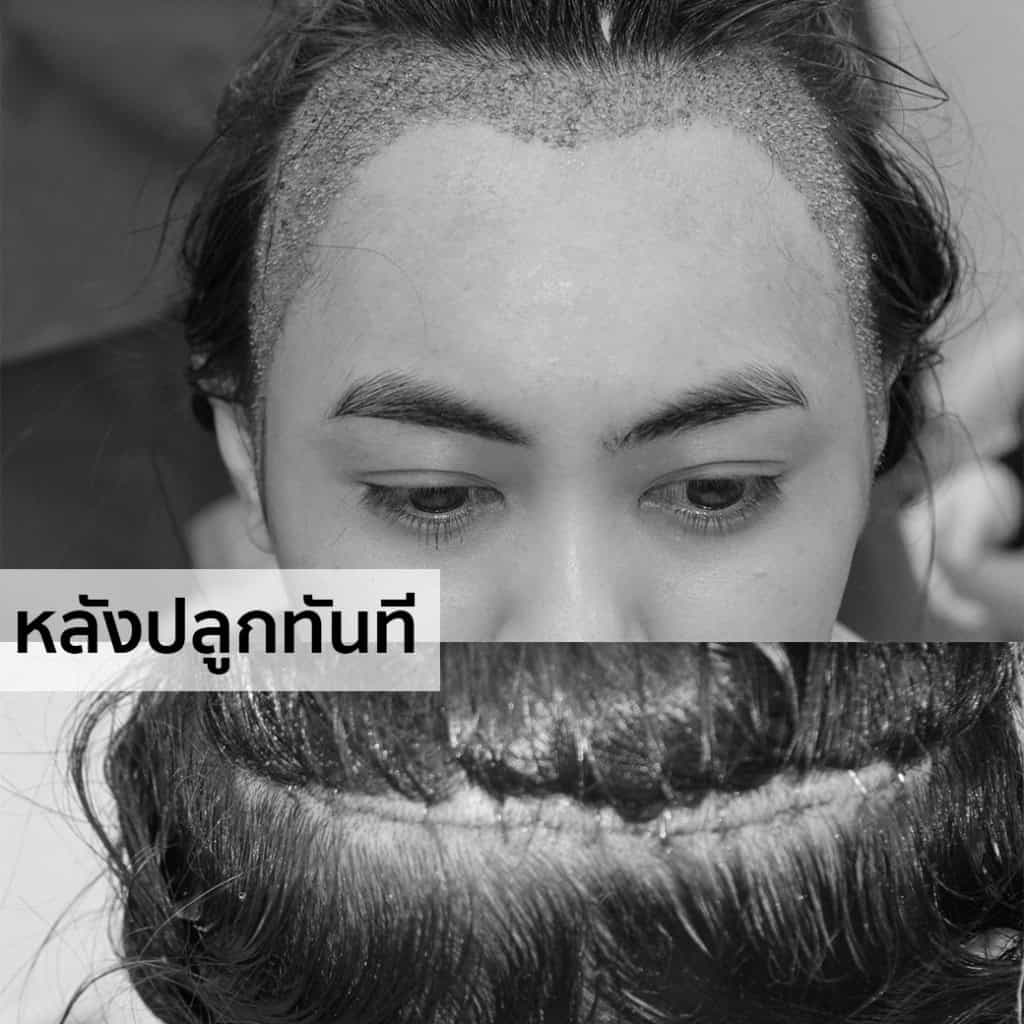 ปลูกผม หมอธิติวัฒน์ เมโกะ MHC คุณน้ำ