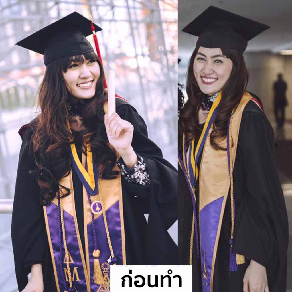 ปลูกผม หมอธิติวัฒน์ เมโกะ MHC คุณน้ำ
