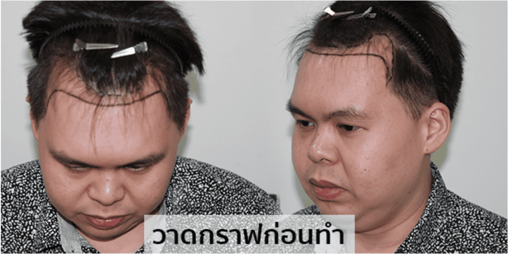 ปลูกผม หัวล้าน ผมบาง หมอธิติวัฒน์ เมโกะ MHCคุณวิกรม