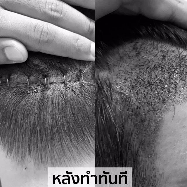 ปลูกผม หัวล้าน ผมบาง หมอธิติวัฒน์ เมโกะ MHCคุณวิกรม