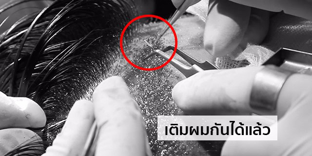 ปลูกผม หัวล้าน ผมบาง หมอธิติวัฒน์ เมโกะ MHCคุณวิกรม