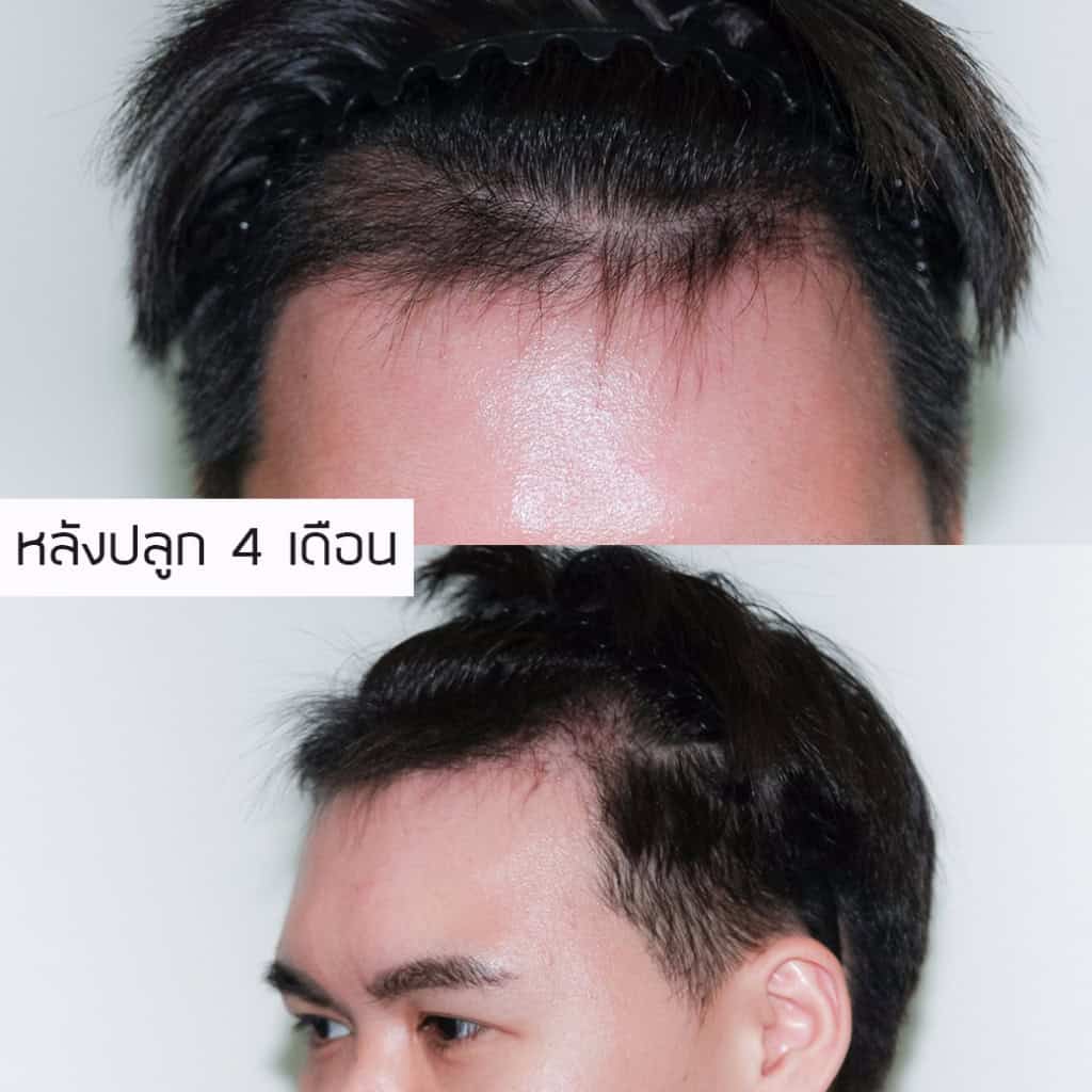 ปลูกผม หัวล้าน ผมบาง หมอธิติวัฒน์ เมโกะ MHCคุณวิกรม