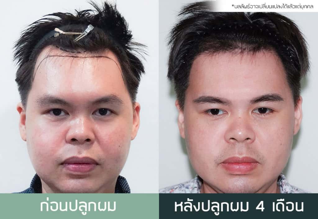 ปลูกผม หัวล้าน ผมบาง หมอธิติวัฒน์ เมโกะ MHCคุณวิกรม