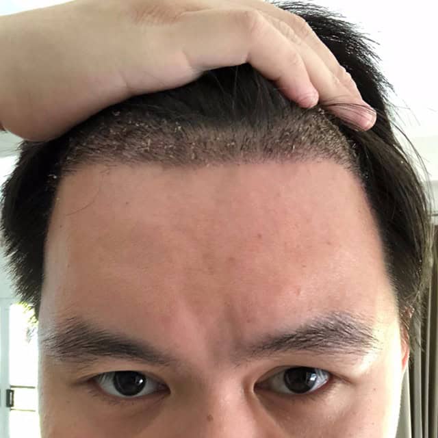 ปลูกผม หัวล้าน ผมบาง หมอธิติวัฒน์ เมโกะ MHCคุณวิกรม