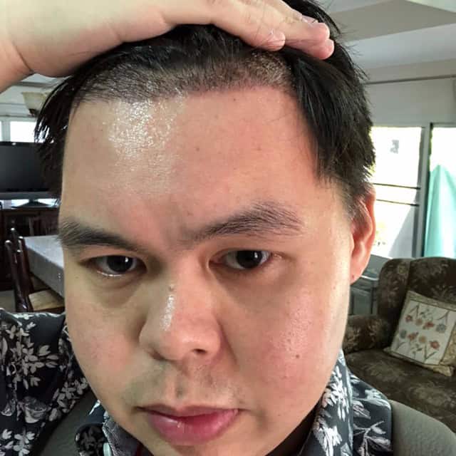ปลูกผม หัวล้าน ผมบาง หมอธิติวัฒน์ เมโกะ MHCคุณวิกรม