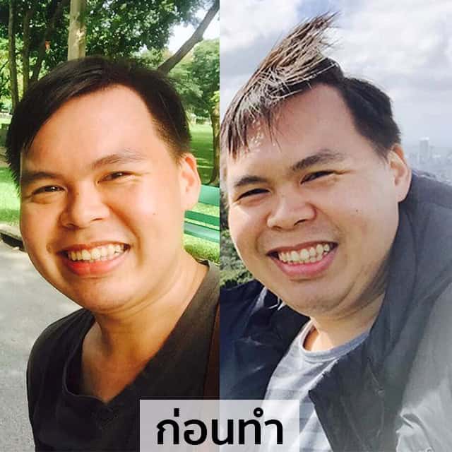 ปลูกผม หัวล้าน ผมบาง หมอธิติวัฒน์ เมโกะ MHCคุณวิกรม