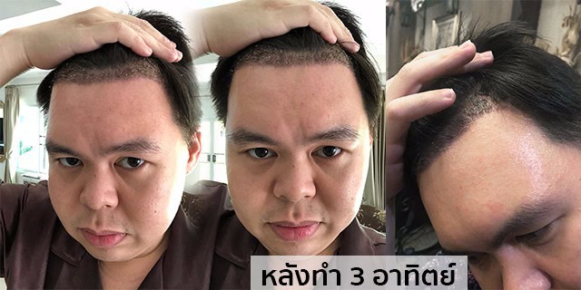 ปลูกผม หัวล้าน ผมบาง หมอธิติวัฒน์ เมโกะ MHCคุณวิกรม