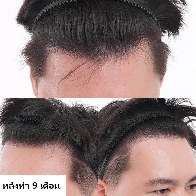 ปลูกผม หัวล้าน ผมบาง หมอธิติวัฒน์ เมโกะ MHCคุณวิกรม