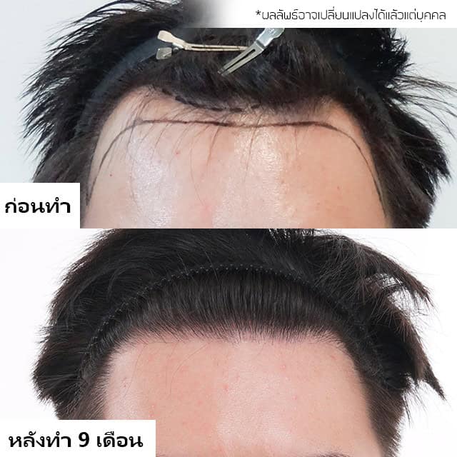 ปลูกผม หัวล้าน ผมบาง หมอธิติวัฒน์ เมโกะ MHCคุณวิกรม