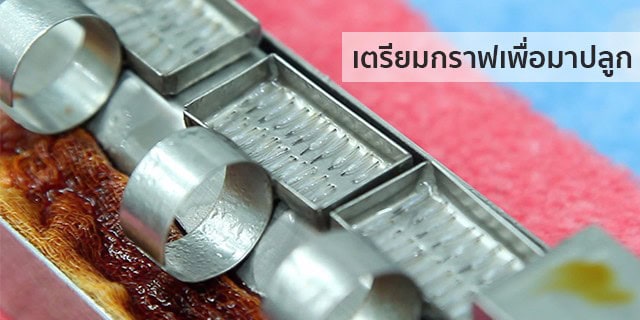 ปลูกผม หัวล้าน ผมบาง หมอธิติวัฒน์ เมโกะ MHCคุณวิกรม