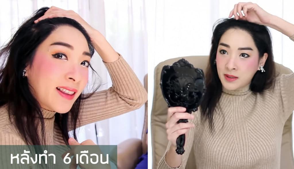 หนูอิมฟ้าว์เฟี้ยว-ปลูกผม-fut