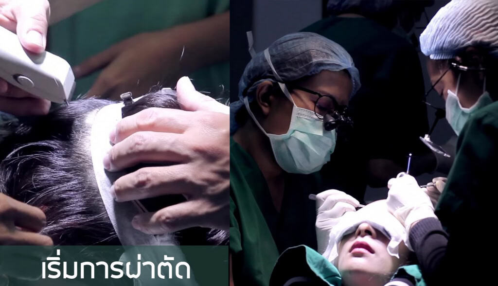 หนูอิมฟ้าว์เฟี้ยว-ปลูกผม-fut