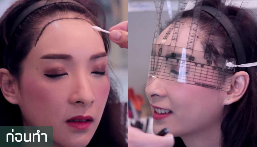 หนูอิมฟ้าว์เฟี้ยว-ปลูกผม-fut