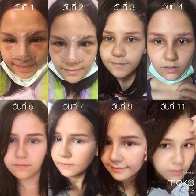 เสริมจมูก โดยหมอมาลา เมโกะ คลินิก คุณตาต้า