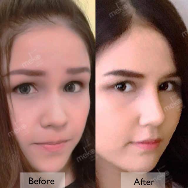 เสริมจมูก โดยหมอมาลา เมโกะ คลินิก คุณตาต้า