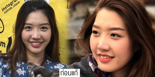แก้จมูกโดยหมอมันสเมโกะคลินิกคุณแอร์