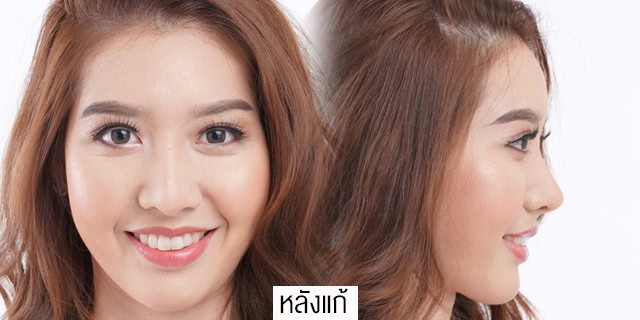 แก้จมูกโดยหมอมันสเมโกะคลินิกคุณแอร์