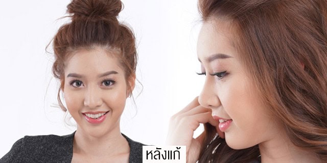 แก้จมูกโดยหมอมันสเมโกะคลินิกคุณแอร์