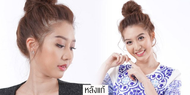 แก้จมูกโดยหมอมันสเมโกะคลินิกคุณแอร์