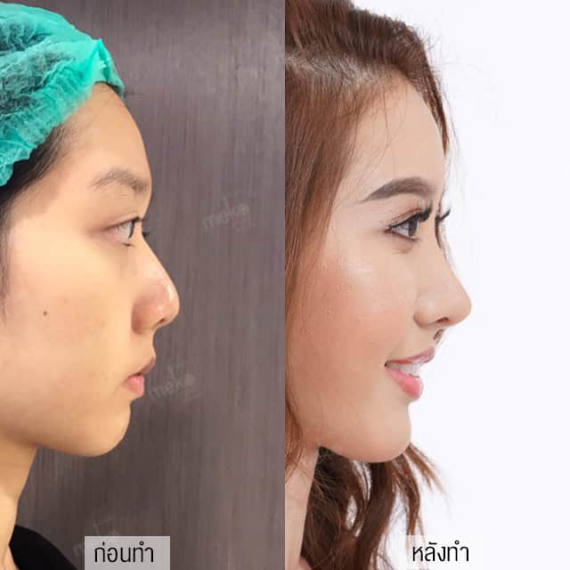 แก้จมูกโดยหมอมันสเมโกะคลินิกคุณแอร์