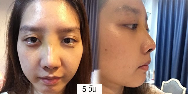 แก้จมูกโดยหมอมันสเมโกะคลินิกคุณแอร์