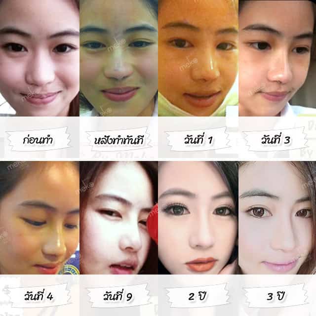 เสริมจมูก-หมอมนัส-เมโกะ-คลินิก-คุณจ๊ะจ๋า