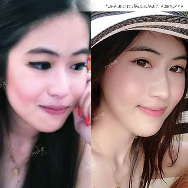 เสริมจมูก-หมอมนัส-เมโกะ-คลินิก-คุณจ๊ะจ๋า