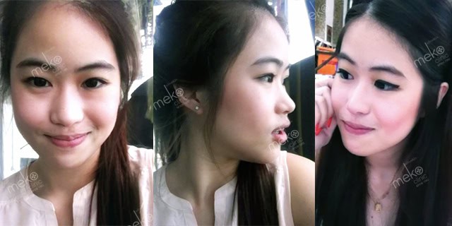 เสริมจมูก-หมอมนัส-เมโกะ-คลินิก-คุณจ๊ะจ๋า