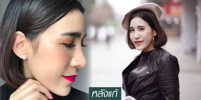 เสริมจมูก-หมอมนัส-เมโกะ-คลินิก-คุณบู