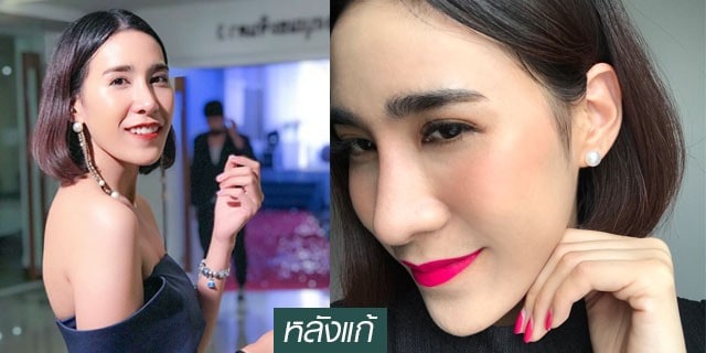เสริมจมูก-หมอมนัส-เมโกะ-คลินิก-คุณบู