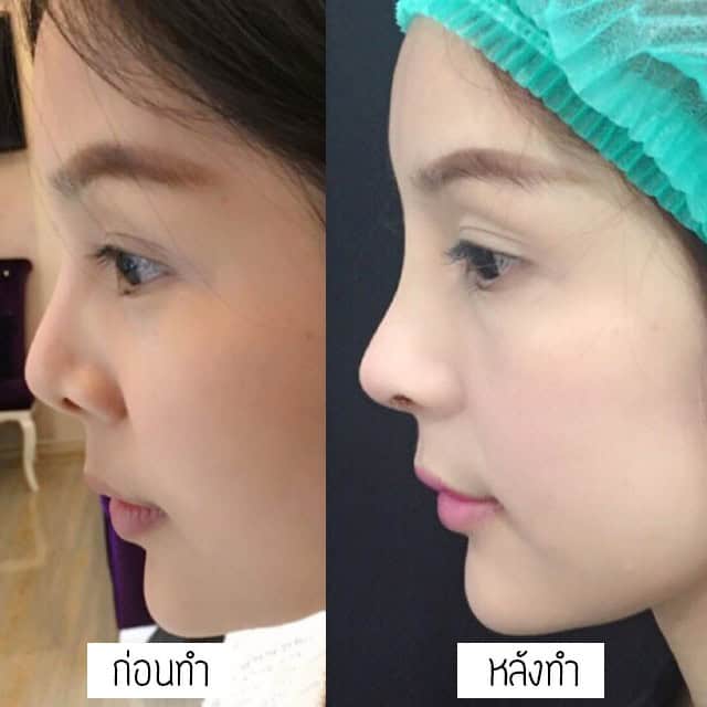 เสริมจมูก แก้จมูก โดยหมออา ที่เมโกะคลินิก คุณโบว์