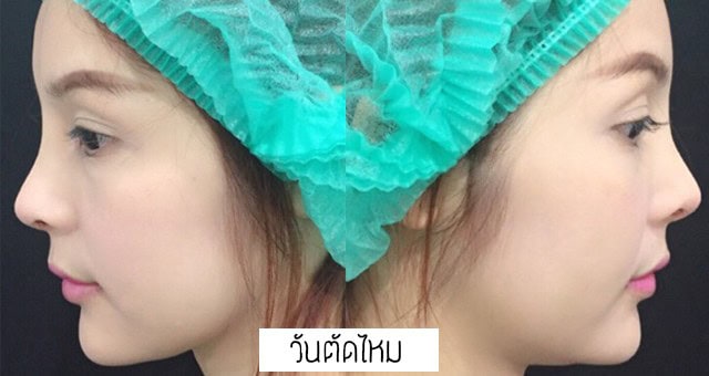 เสริมจมูก แก้จมูก โดยหมออา ที่เมโกะคลินิก คุณโบว์