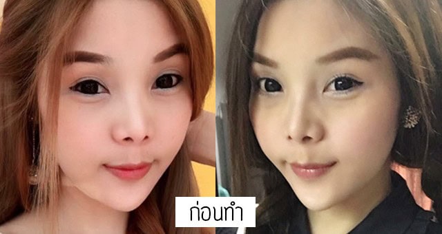 เสริมจมูก แก้จมูก โดยหมออา ที่เมโกะคลินิก คุณโบว์