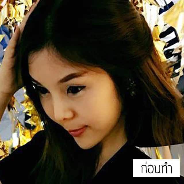 เสริมจมูก แก้จมูก โดยหมออา ที่เมโกะคลินิก คุณโบว์