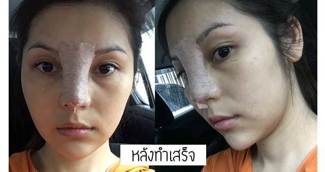 เสริมจมูก แก้จมูก โดยหมออา ที่เมโกะคลินิก คุณโบว์